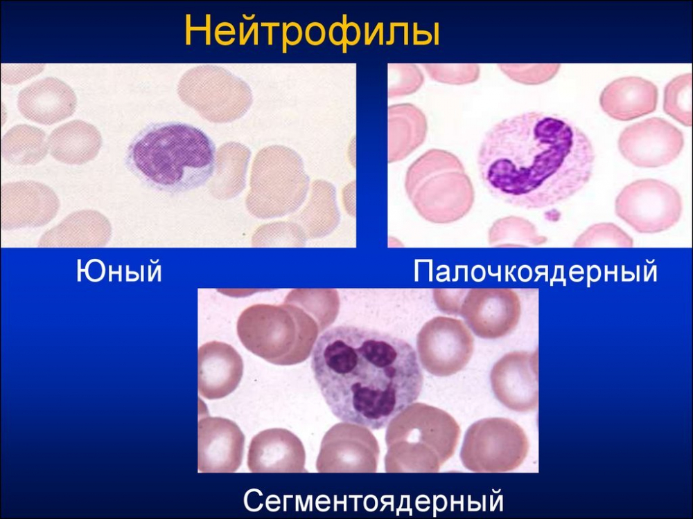 палочкоядерные нейтрофилы повышены причины